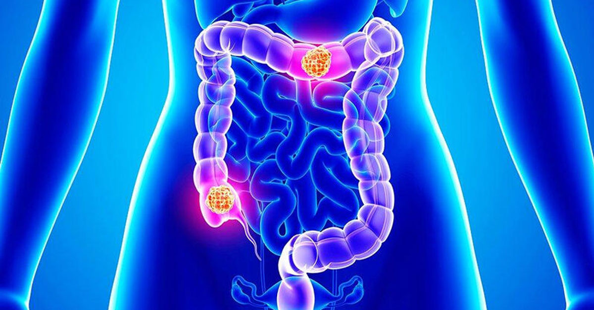 intestent cance