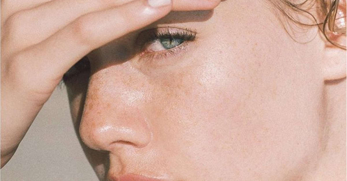 melasma face girl close