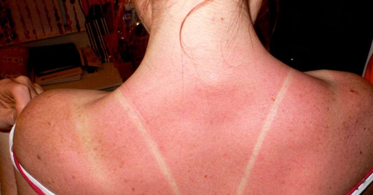 sunburn back