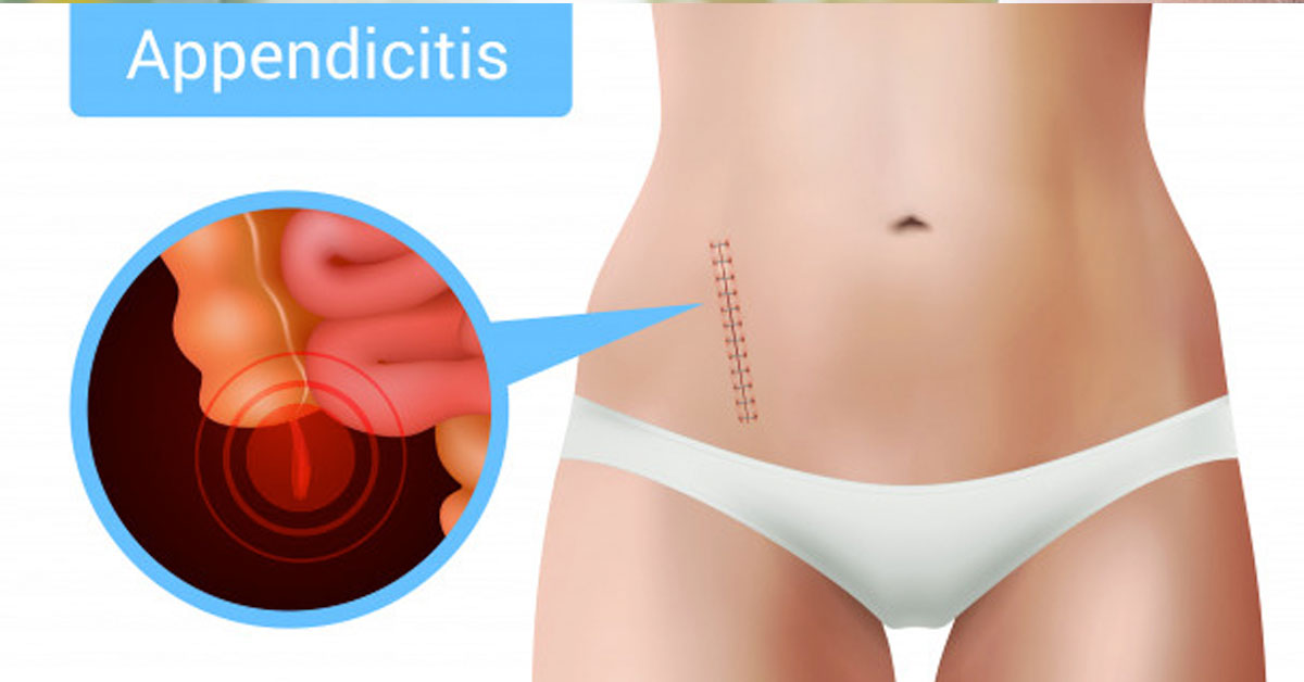 appendicitis