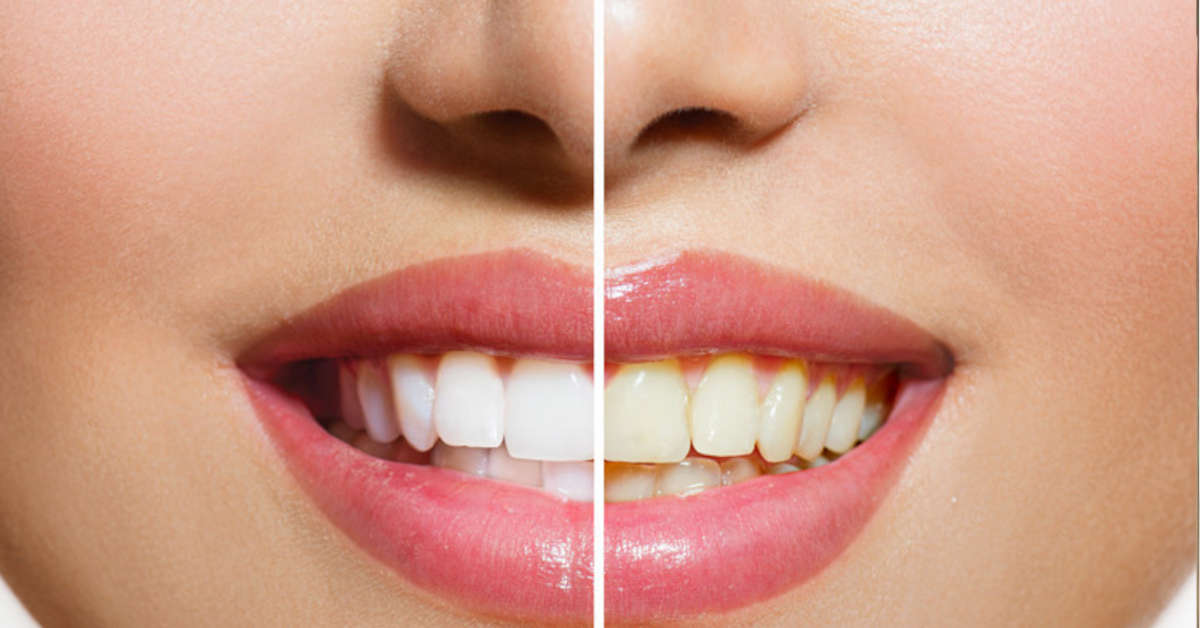 white teeth before after
