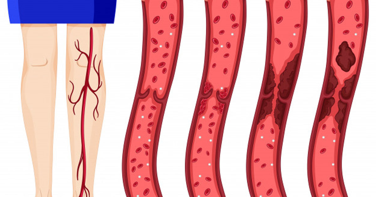 fleviki thromvosi