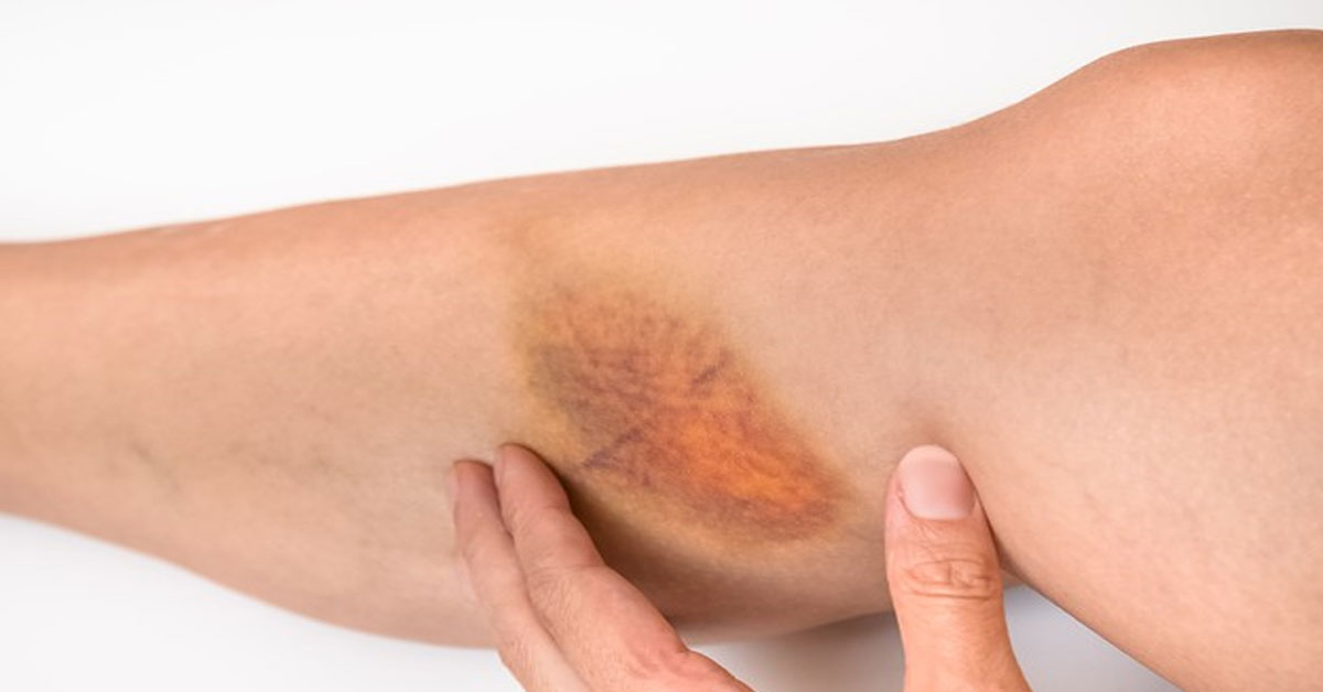 bruise