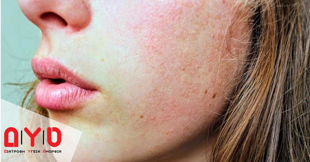 dermatitida cover proswpo