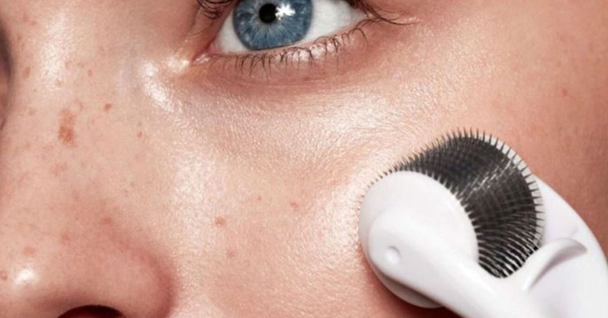 microneedling