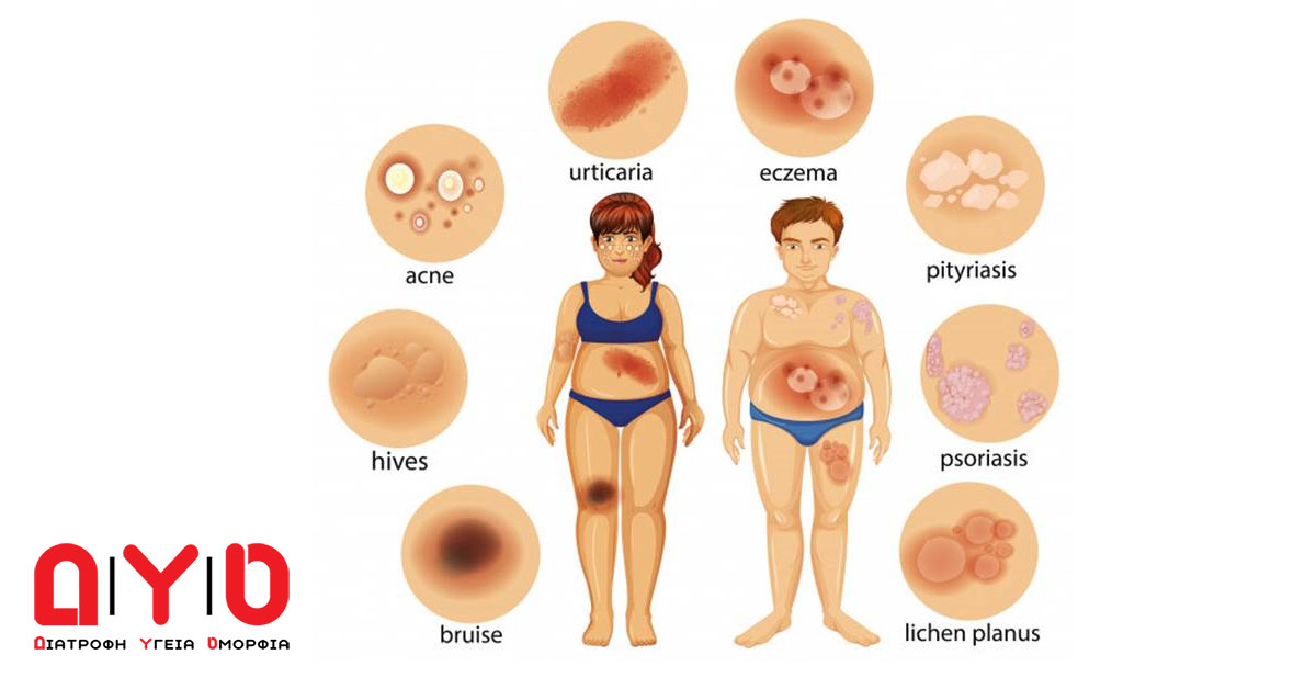 psoriasi infographic