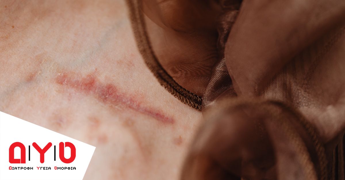 scars