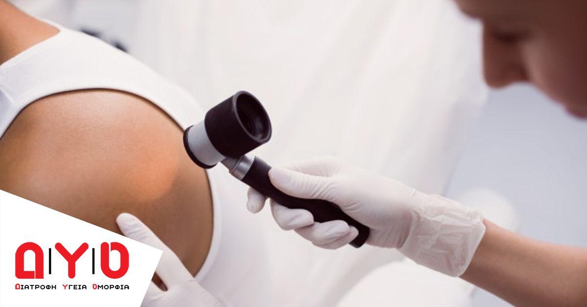 melanoma