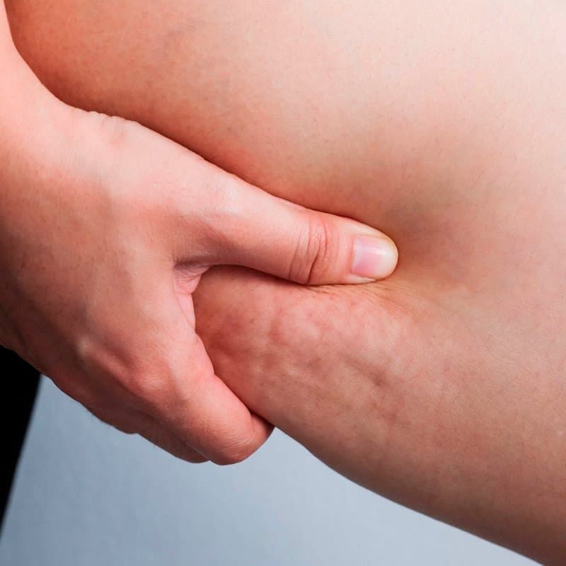 Cellulite11 1