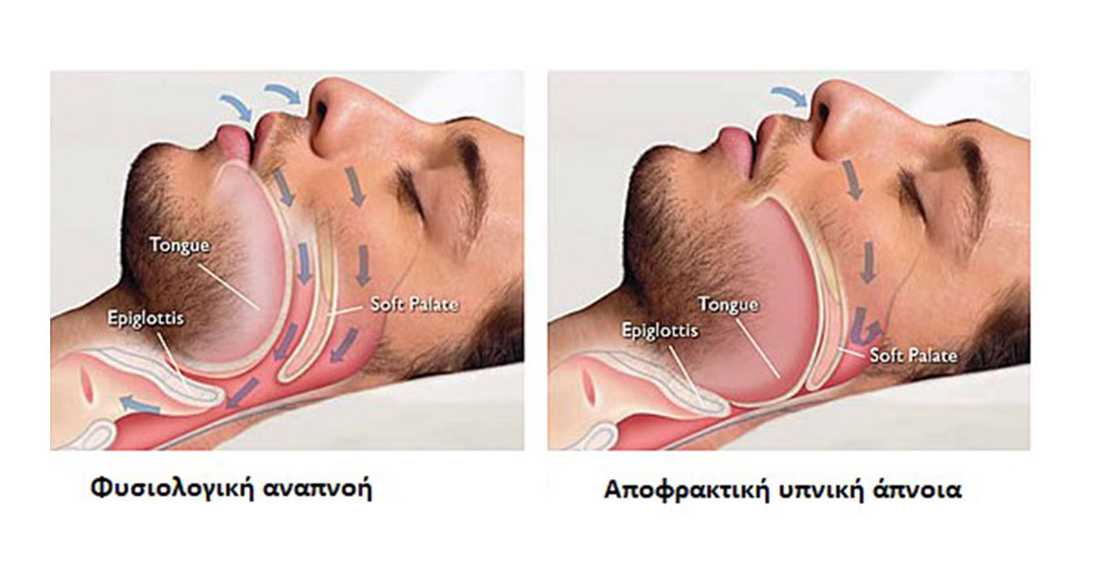 apnoia