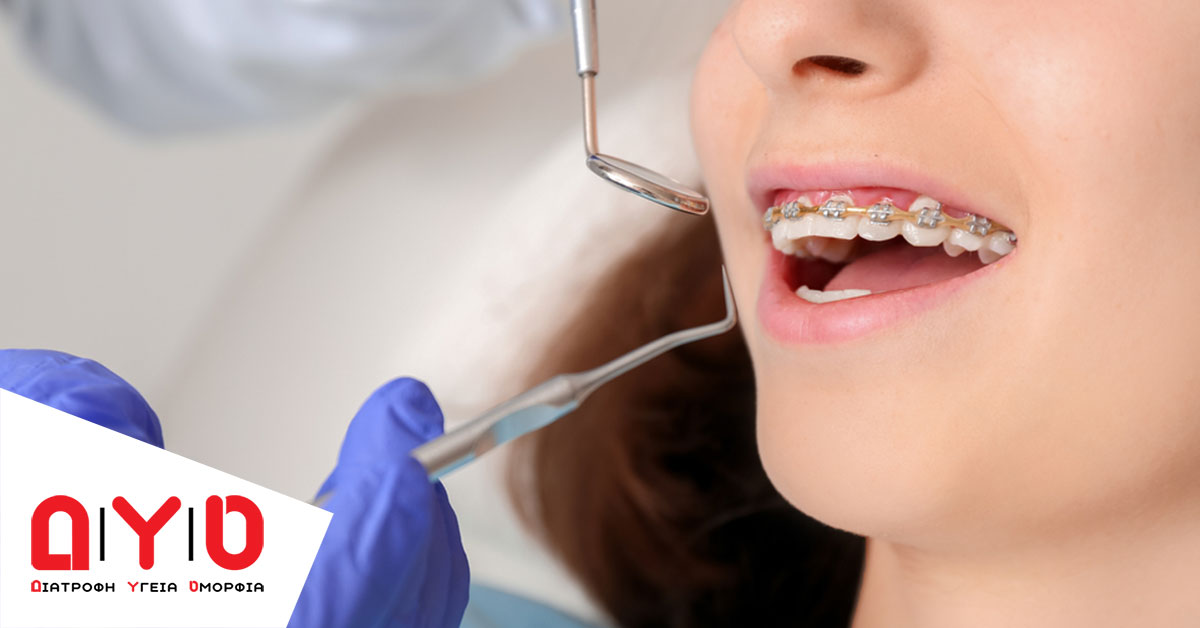 braces