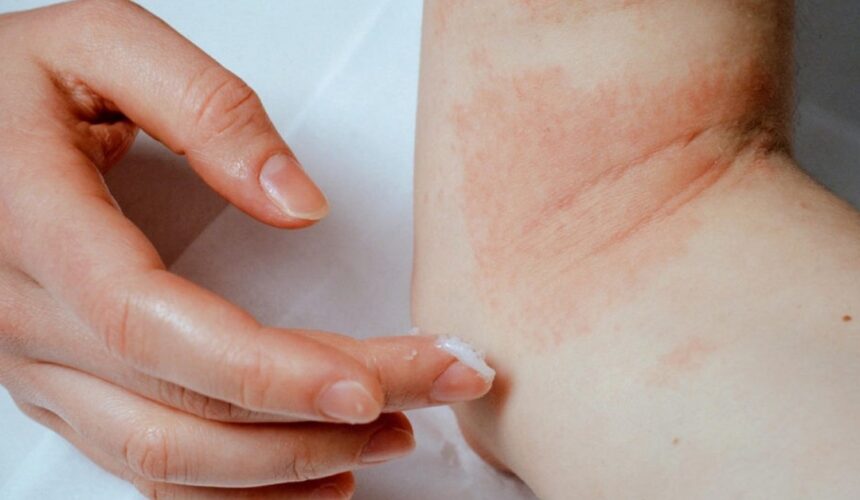 atopiki_dermatitida-dyomagazine