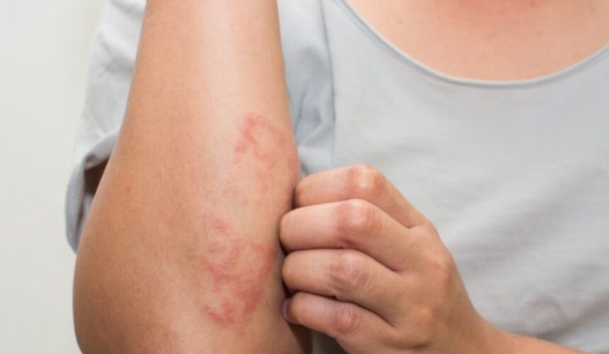 psoriasi-870x470-1