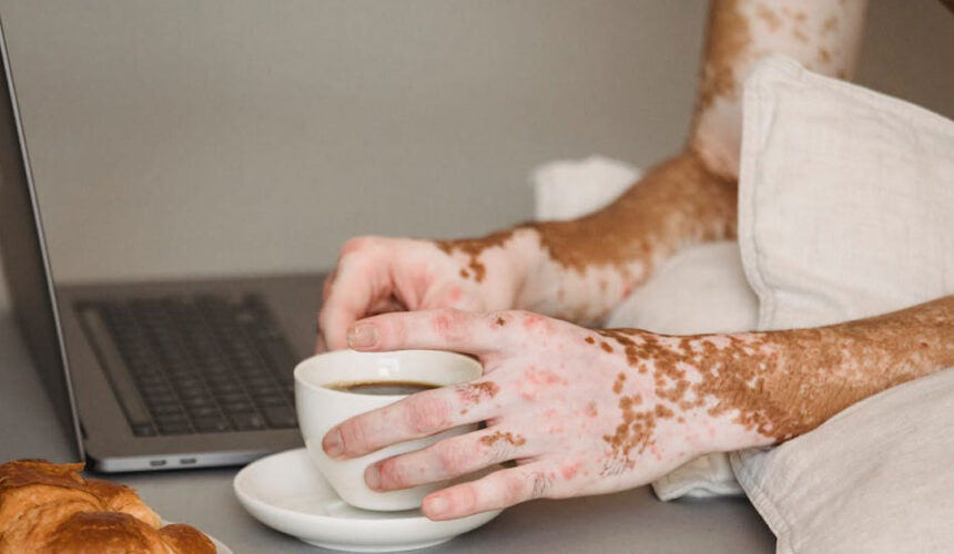 psoriasis