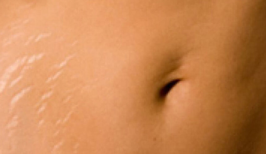 Ραβδώσεις – Ραγάδες – Skin Streak Lift