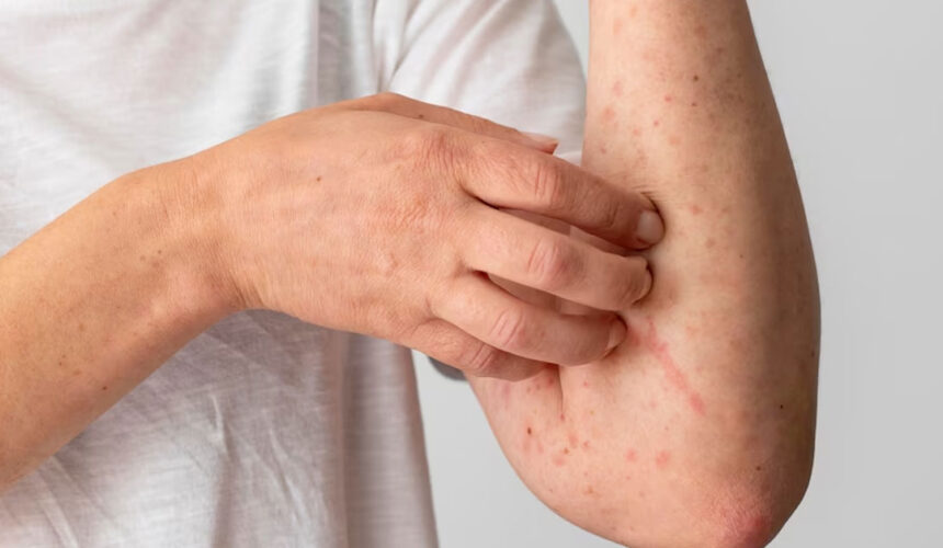 skin-allergy-reaction