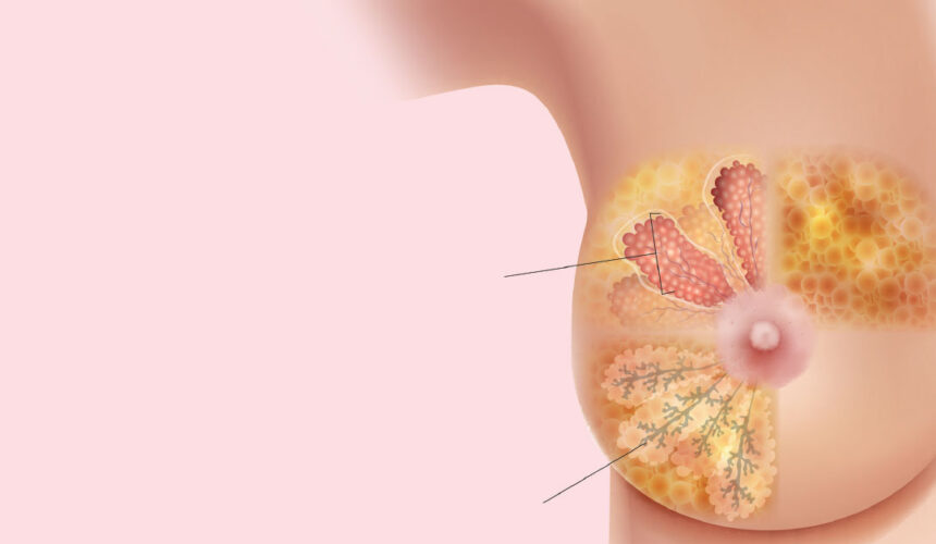 breast-cancer
