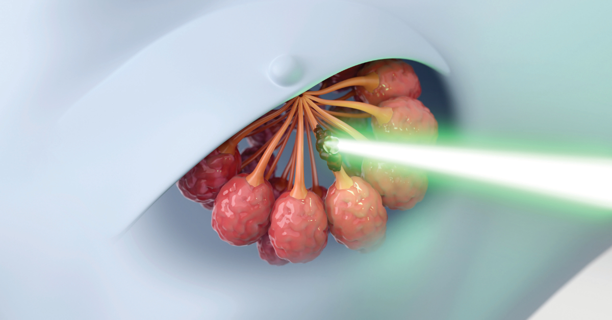 Καρκίνος Μαστού  & Ακτινοθεραπεία Νέες τεχνικές  & εξατομικευμένες  επιλογές